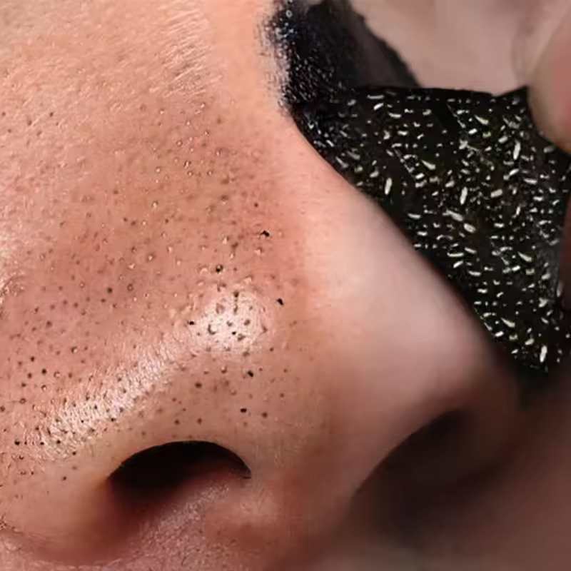 5pcs Nose Blackhead Remover